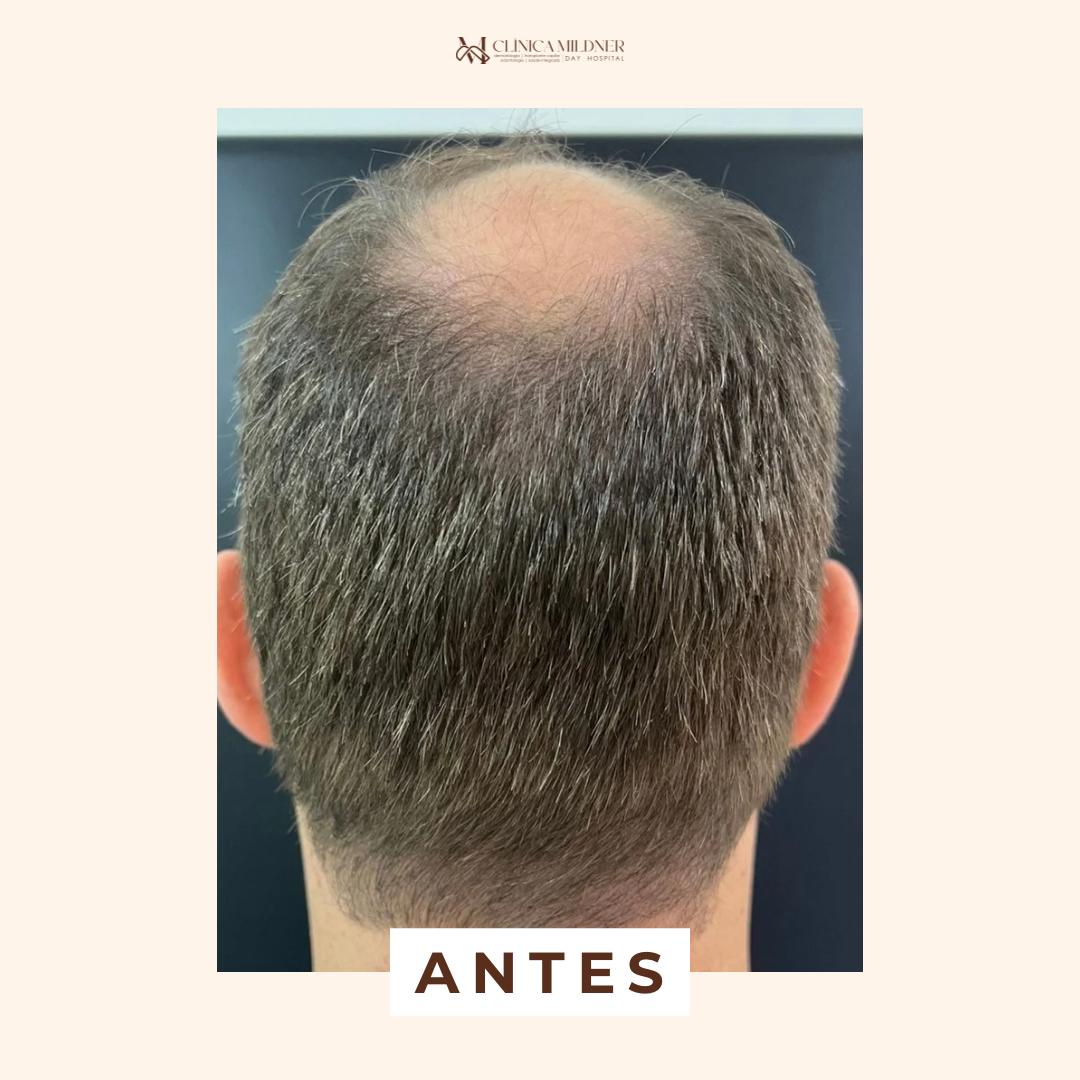 antes antes